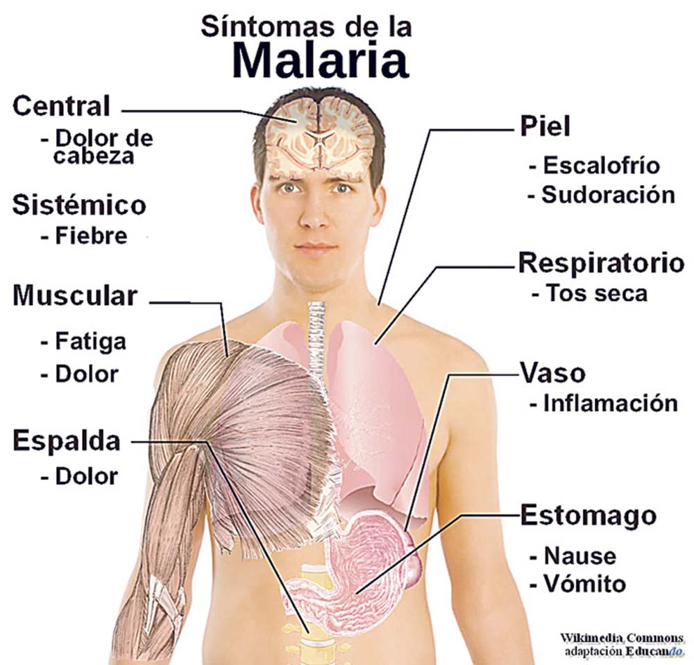 sintomas-de-la-malaria
